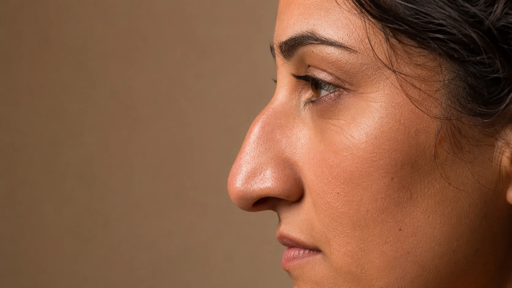 Nariz con caballete — rinomodelación en armonización facial, Spazio Barcelona