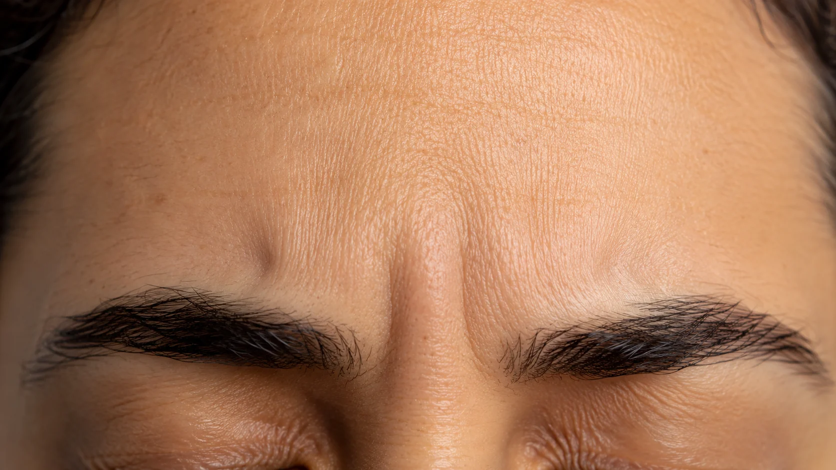 Arrugas del entrecejo — zona de tratamiento con botox en Spazio Barcelona