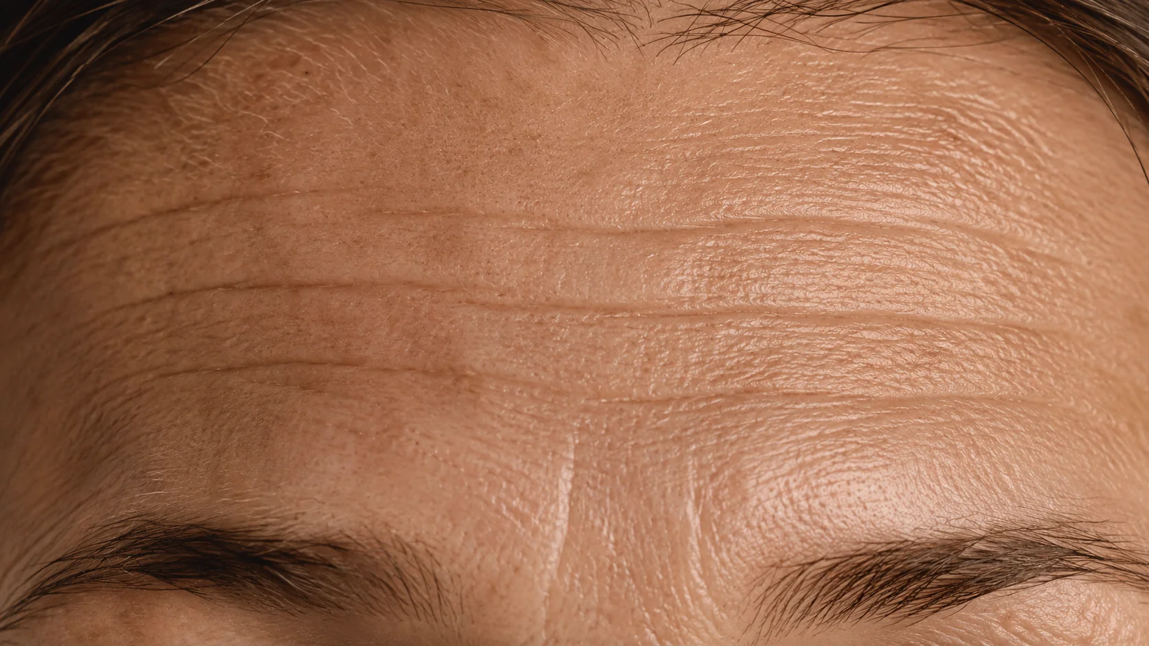 Arrugas horizontales en la frente — zona de tratamiento con botox en Spazio Barcelona