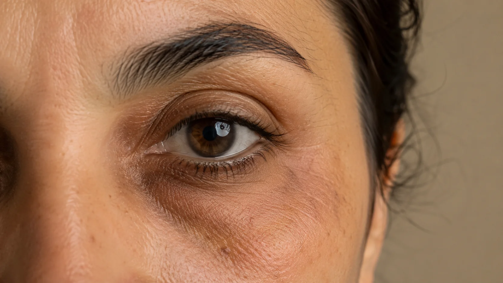 Ojeras pigmentadas — manchas oscuras por exceso de melanina en la zona periocular, Spazio Barcelona